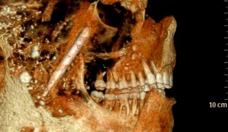 Descubren el secreto de las dentaduras perfectas de los antiguos romanos