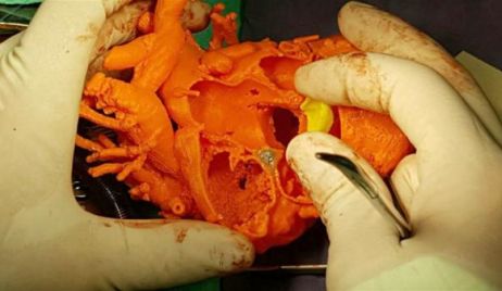 Córdoba: Un corazón 3D le salvó la vida a un nene