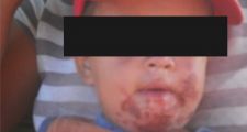 Campo Hardy: Denuncian secuelas de la fumigación de algodón en niños