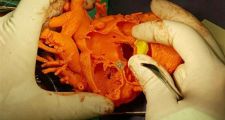 Córdoba: Un corazón 3D le salvó la vida a un nene
